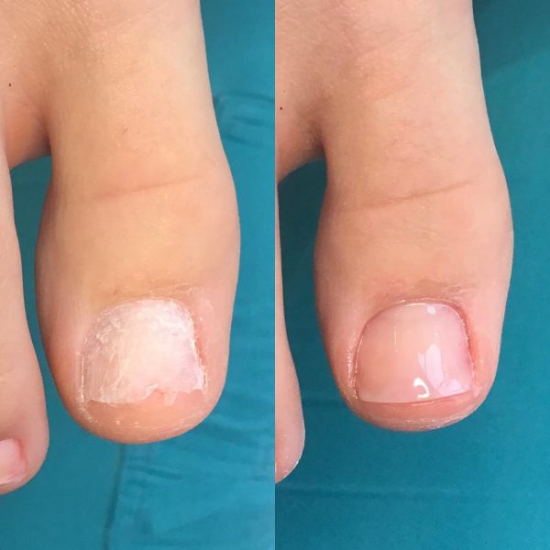 Izobraževanje za nohtno protetiko z metodo NEC