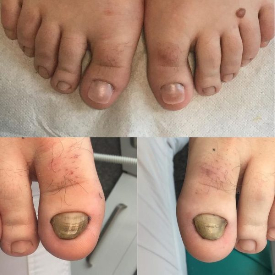 Izobraževanje za nohtno protetiko z metodo NEC