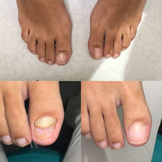 Izobraževanje za nohtno protetiko z metodo NEC