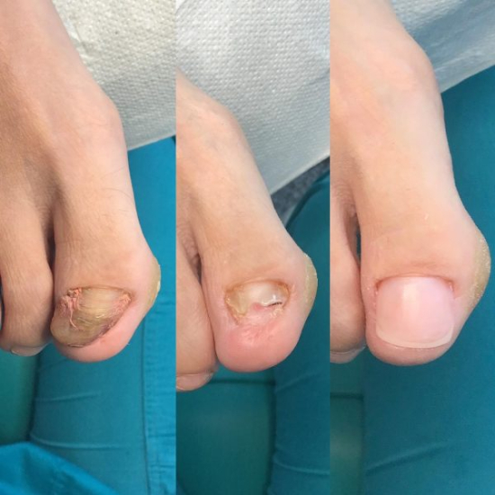 Izobraževanje za nohtno protetiko z metodo NEC